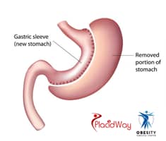 Slider image (2) Obesity Surgical Center | Dr. Jorge Reyes Mendiola